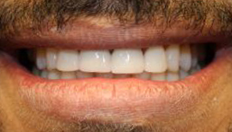 Smile after veneers and crown placement