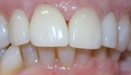 Smile after front veneers and dental crowns