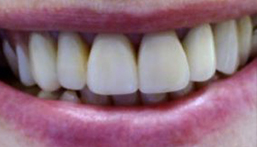 Smile after front dental crown placement