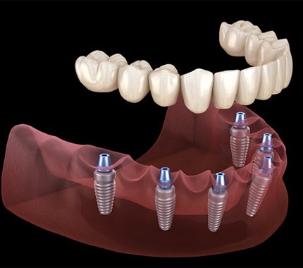 A digital image of an implant denture being placed over the top of 6 dental implants on the lower arch