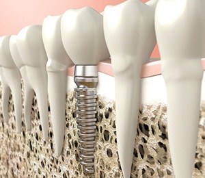Diagram of dental implant in Hillsboro after placement