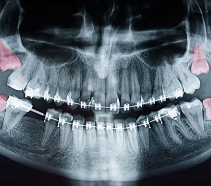 Dental X-ray showing four wisdom teeth