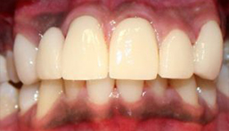 Smile after fixed bridge placement