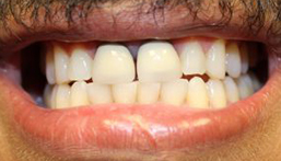 Smile before veneers and crown placmeent