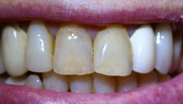 Smile before front dental crown placement