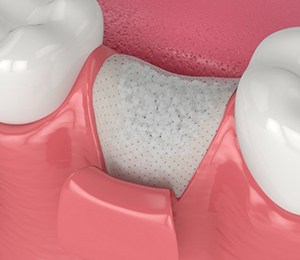 a 3 D illustration of a bone graft