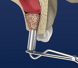 a 3 D illustration of a sinus lift