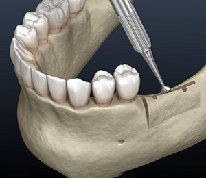 a 3 D illustration of a ridge expansion procedure