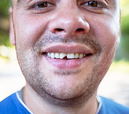 dental patient admiring smile in mirror after dental bonding in Hillsboro 