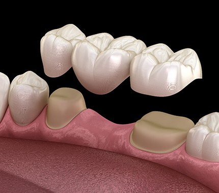 Dental bridge on a clay model