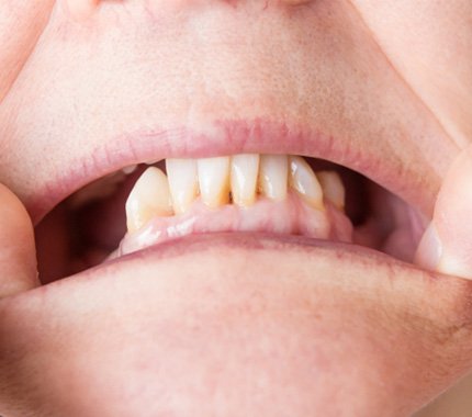 closeup of a person showing their missing teeth