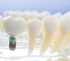 Model of dental implants in Hillsboro