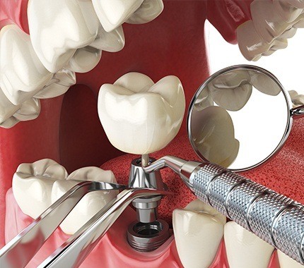 Diagram of single tooth dental implant in Hillsboro being placed