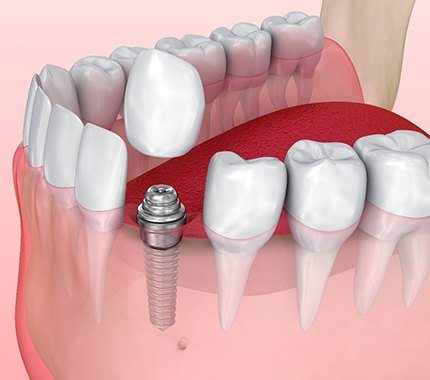 Diagram of dental implants in Hillsboro