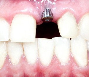 Closeup of dental implant post after placement
