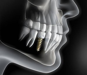 X-ray diagram of dental implants in Hillsboro