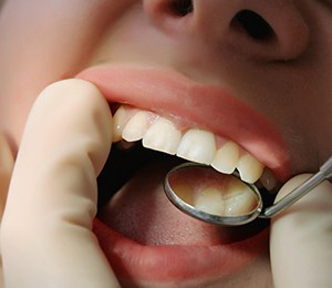 Patient receiving a dental exam from a dentist