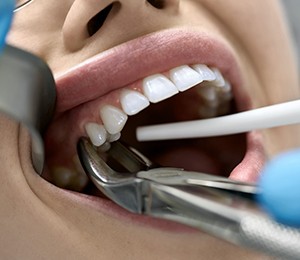 A dentist performing a tooth extraction