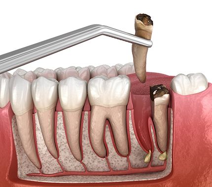 3-D image of a tooth extraction