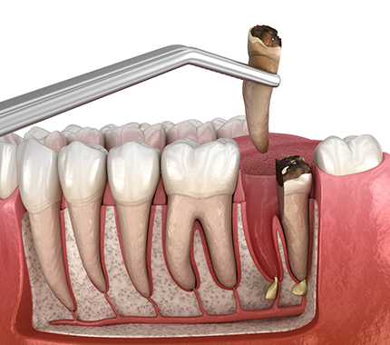 3-D image of a tooth extraction