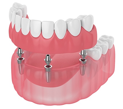 Closeup of a set of full dentures in Hillsboro on a white background
