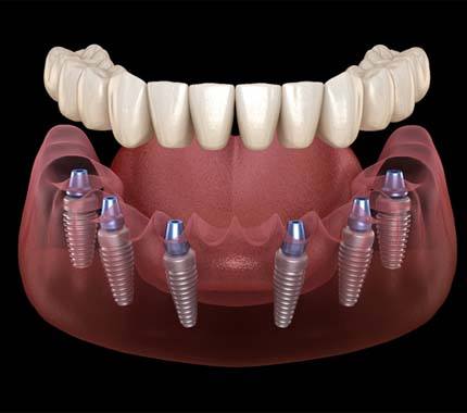 Illustration of implant denture for lower arch against dark background