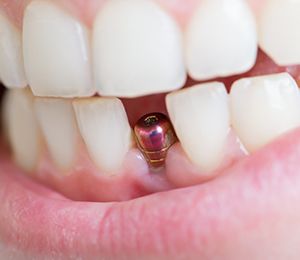 Closeup of patient’s smile after dental implant surgery in Hillsboro