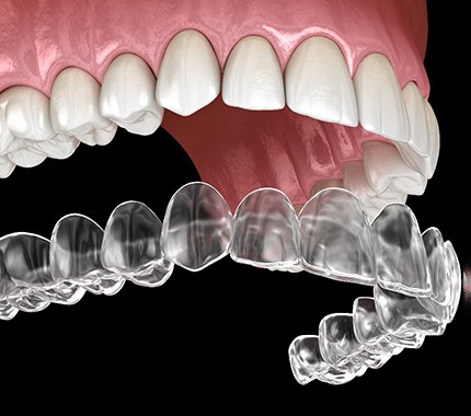 Illustration of Invisalign in Hillsboro, OR being placed on upper arch