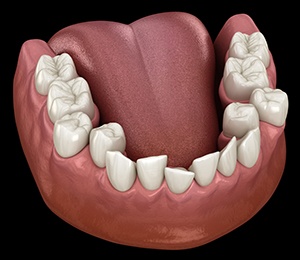 Illustration of crooked teeth