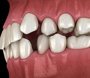 Illustration of gapped teeth