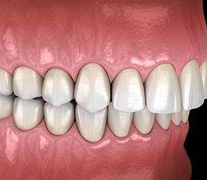 Illustration of an overbite
