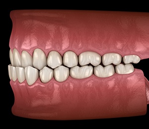 Illustration of an underbite