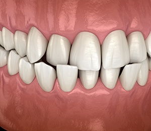 Illustration of a crossbite