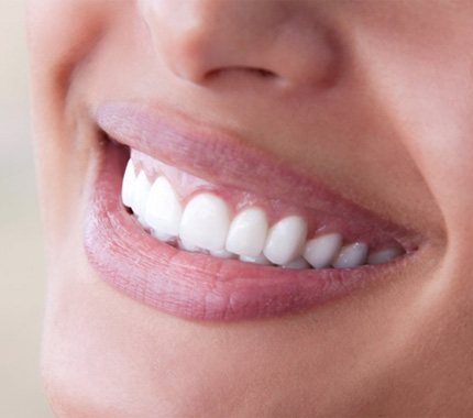 Closeup of a patient’s smile after a smile makeover in Hillsboro