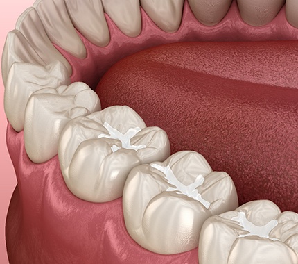 illustration of metal free restorations in Hillsboro