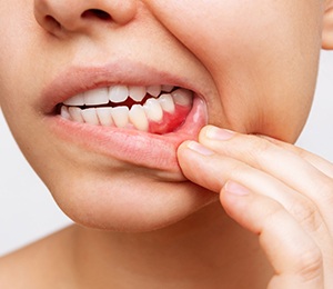 Woman pulling down lips to show signs of gum disease in Hillsboro, OR