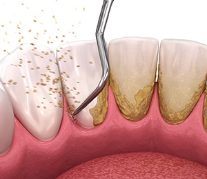 Illustration of cleaning portion of scaling and root planing in Hillsboro, OR