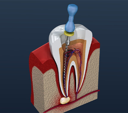 illustration of root canal therapy in Hillsboro