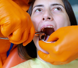 A tooth being pulled to avoid the cost of a root canal in Hillsboro