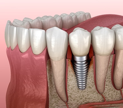 Illustration of bone loss around a failed dental implant in Hillsboro, OR