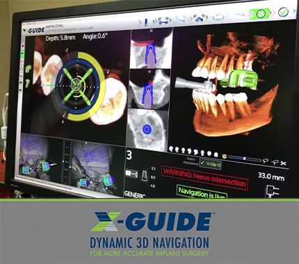 The x-guide surgical dental implant placement system