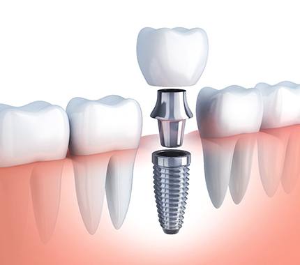 Model showing the parts of a dental implant.