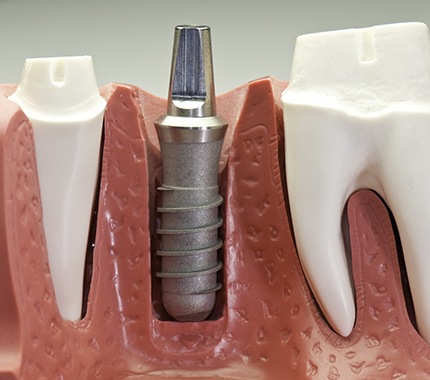 Model of a titanium implant post.