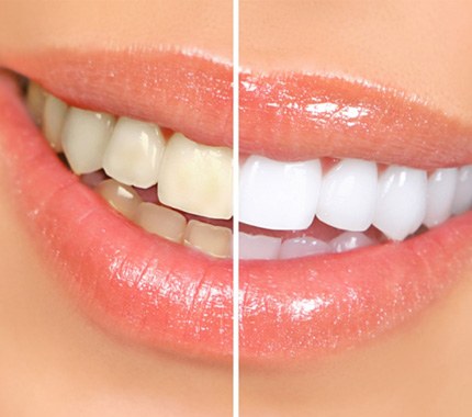  Close up of a whitened smile
