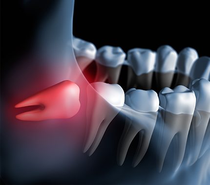 Animation of impacted wisdom tooth