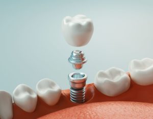 CGI of the different parts of a dental implant 